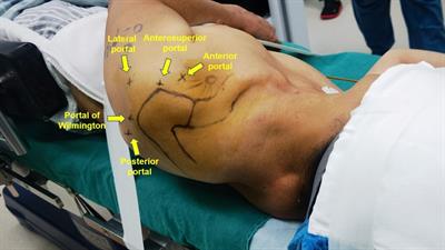 The high resistance loop (H-loop) technique used for all-inside arthroscopic knotless suprapectoral biceps tenodesis: A case series